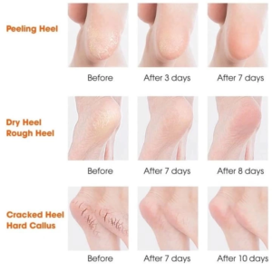 Silikon Topuk Nemlendirici Çorap